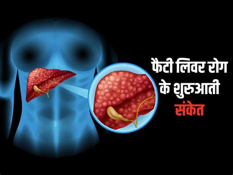 feti levar|Fatty Liver in Hindi 